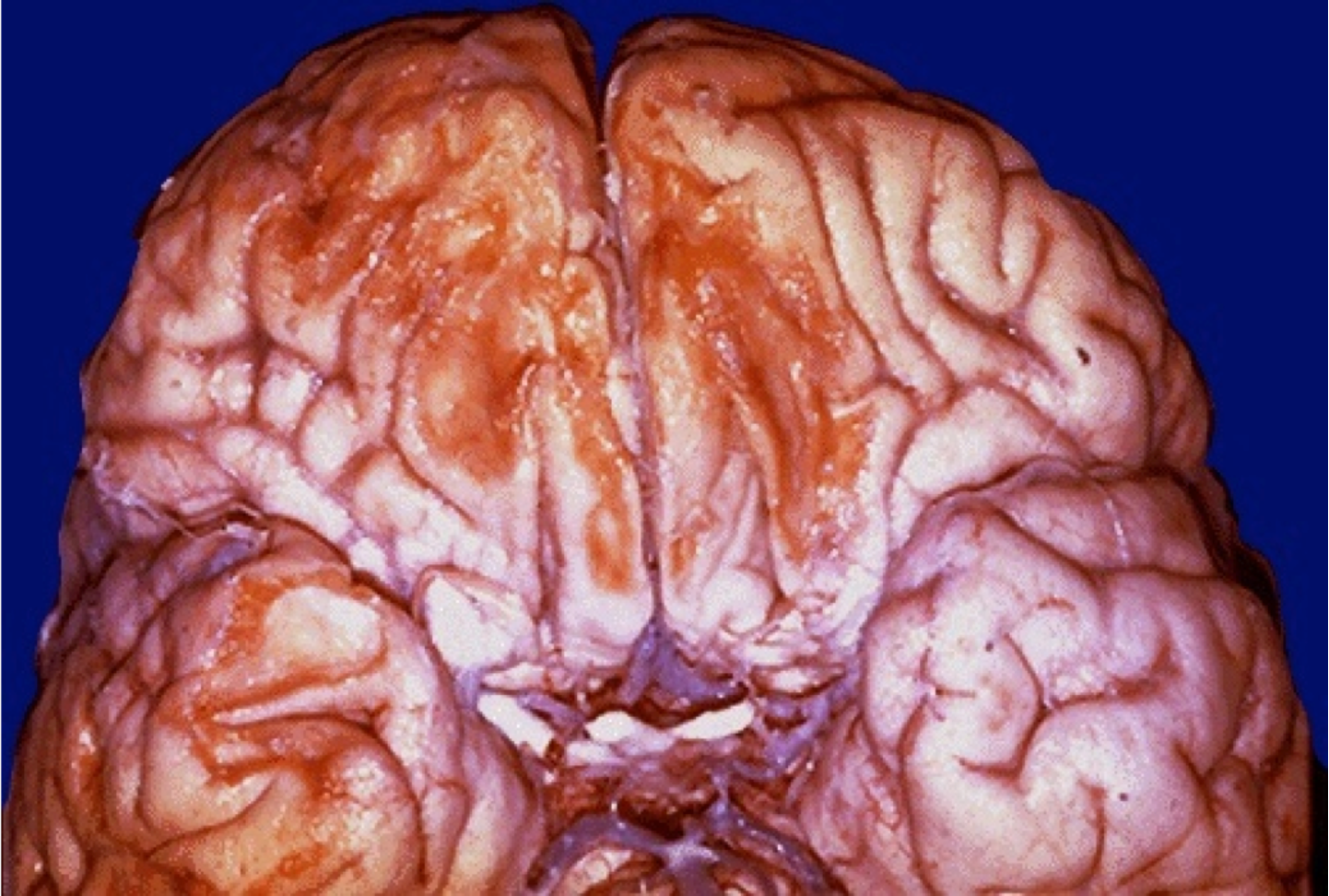 <p>What does the term "sore brain" refer to in the context of traumatic brain injury?</p>