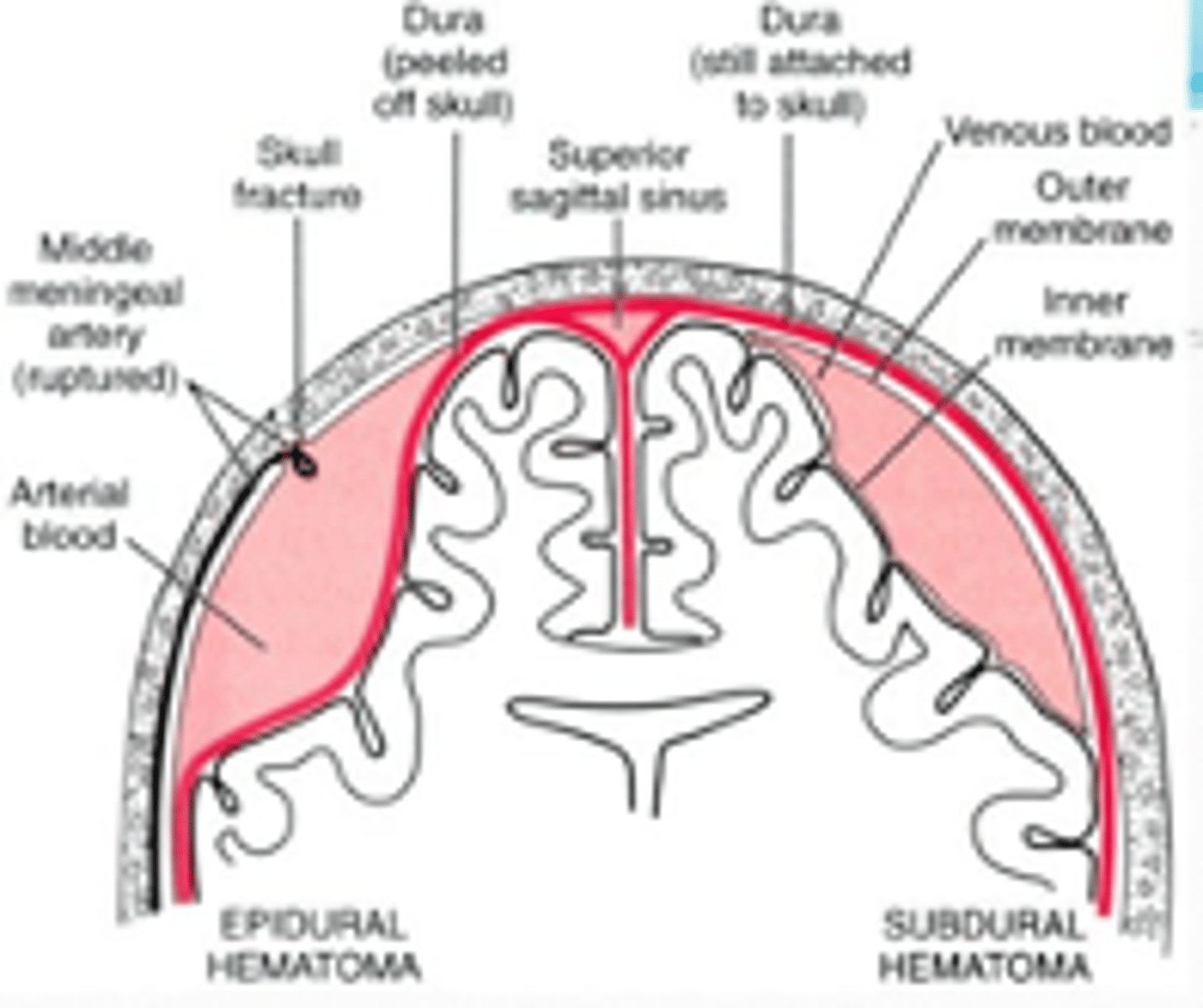 <p>•Subdural hematoma</p><p>•Epidural hematoma</p><p>•Cerebral contusion</p><p>•Intracerebral hemorrage</p><p>•Brain abcess (rare)</p><p>•Cerebral infarction (stroke)</p><p>•Brain tumor</p>