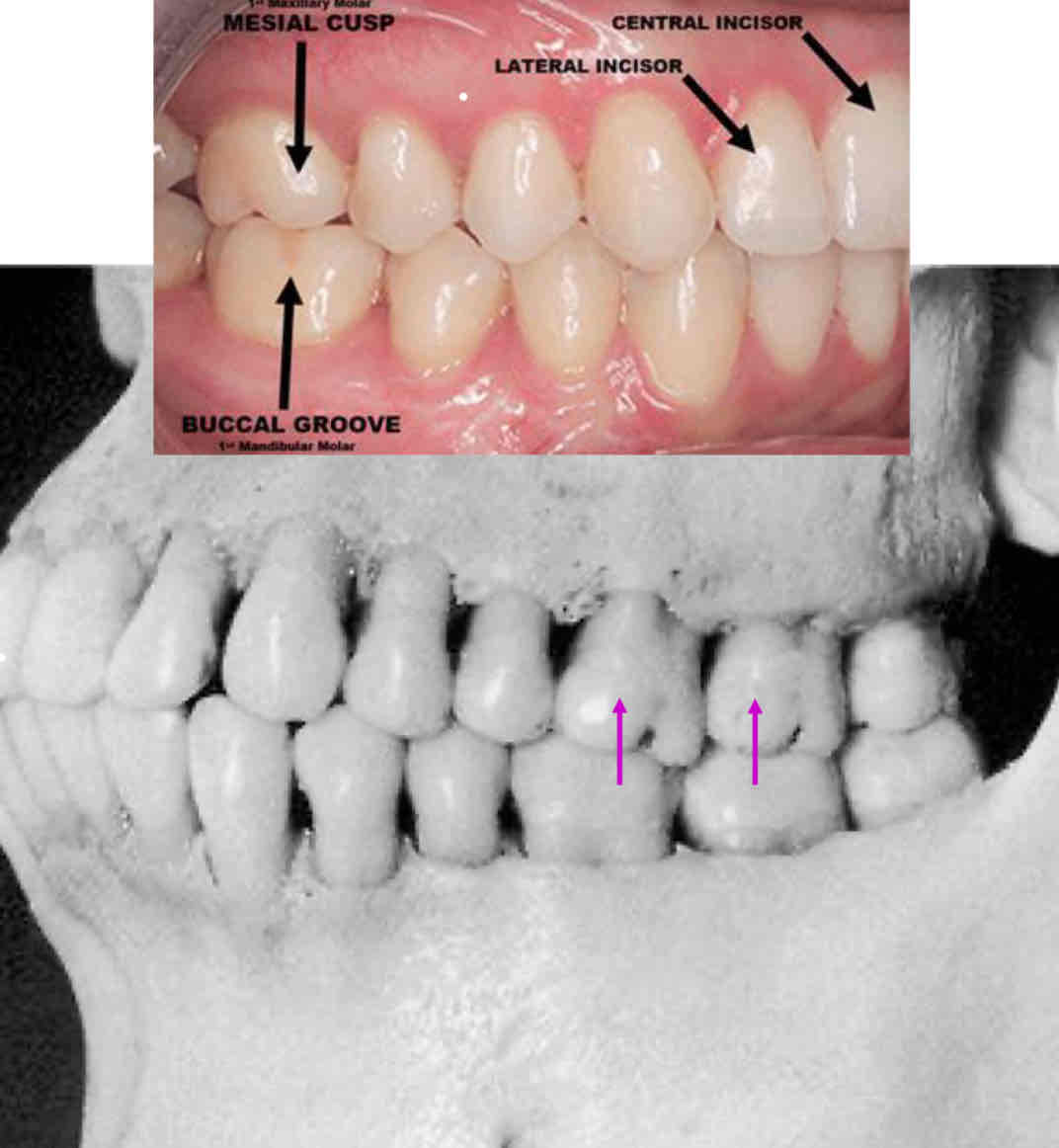 <p>which tooth does the man. first molar occlude with and which part of the tooth is it?</p>
