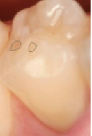 <p>initial loss of surface texture </p>