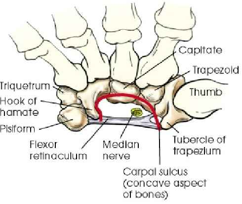 <p>-area between flexor &amp; red line</p><p>-compression of median nerve</p>