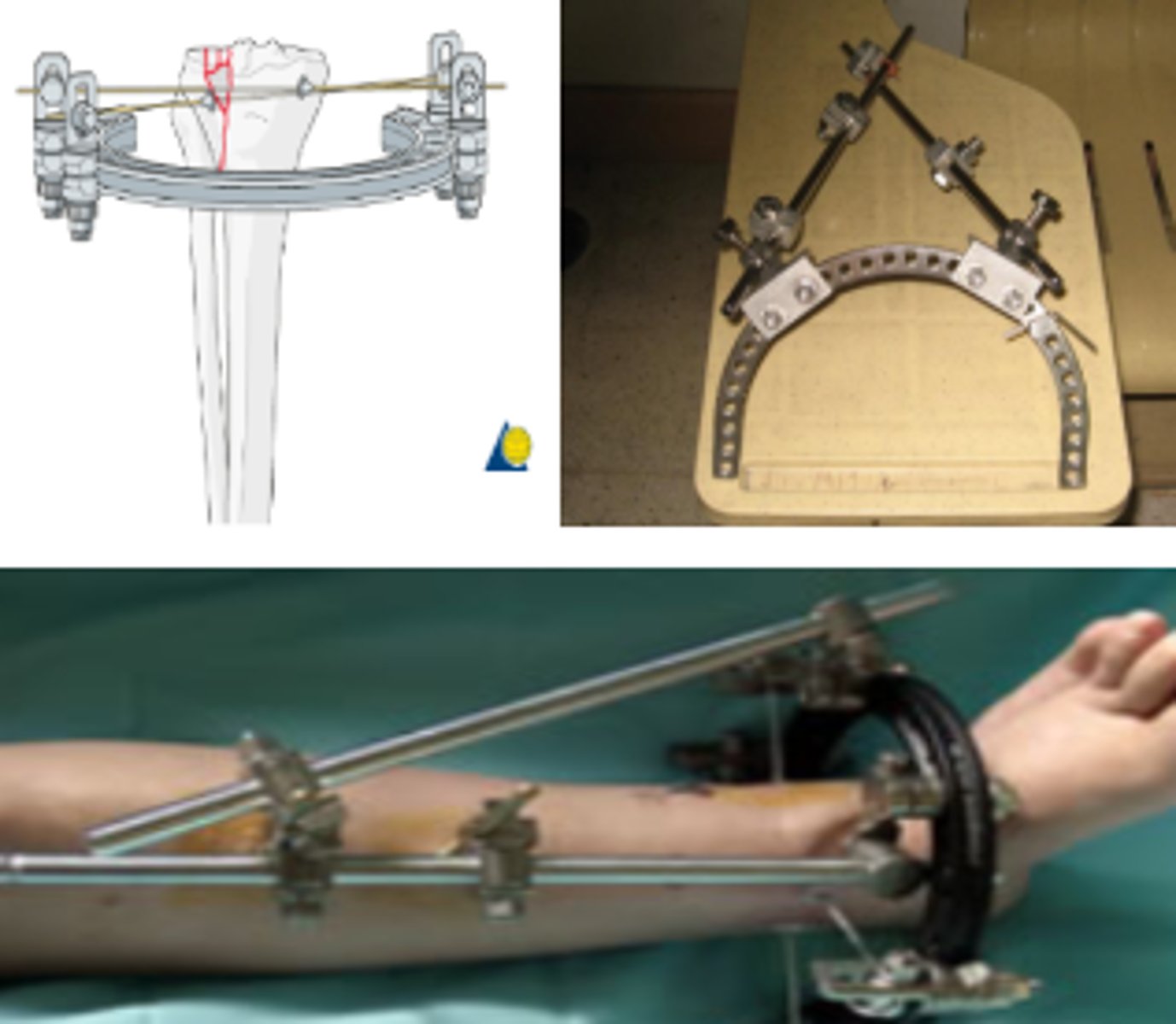 <p>For periarticular fracture of the ankle or knee joint</p>