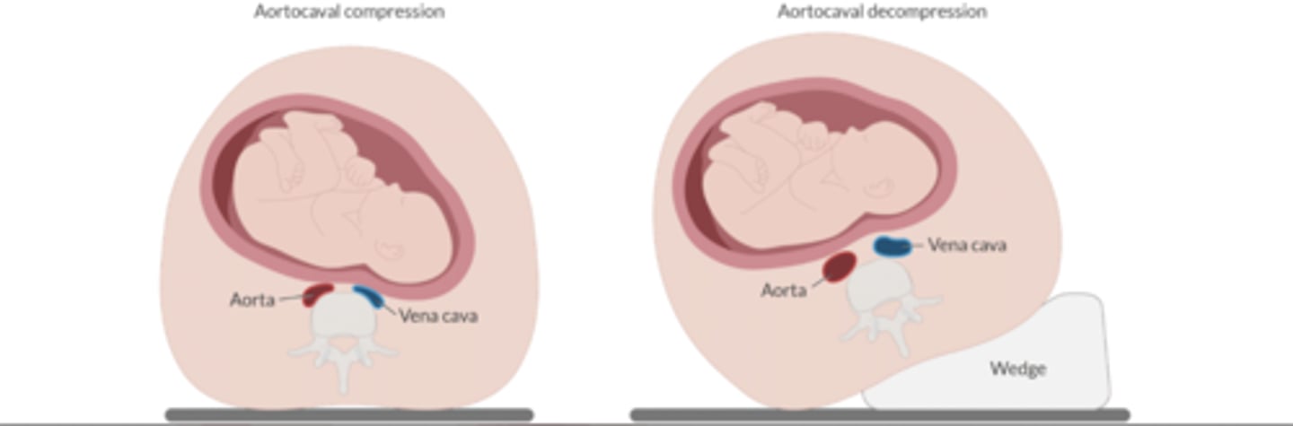 <p>Pregnant women</p><p>In supine, a gravid uterus compresses both the vena cava + the aorta. This ↓ venous return + arterial flow to the uterus + LE. ↓ CO compromises fetal perfusion + cause the mother to lose consciousness.</p><p>Tx: LUD: elevate mother's right torso 15º</p>