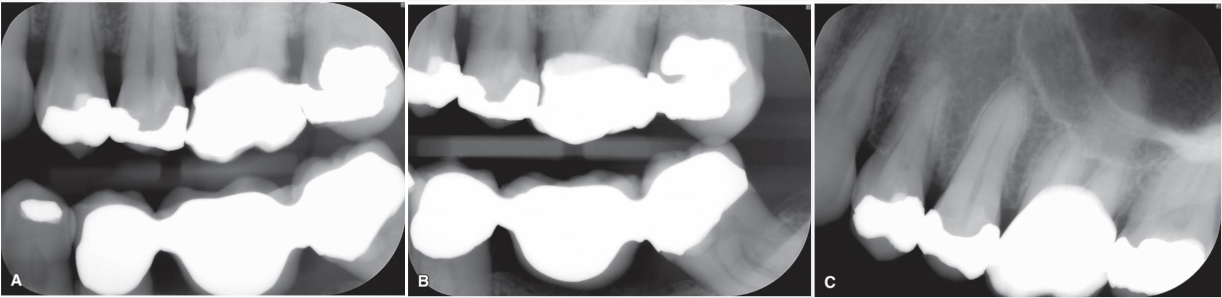 <p><span style="color: #000000">A. BW with correct vertical and horizontal angulation of x-ray beam demonstrating carious lesion on the distal surface of the maxillary left first molar.</span></p><p><span style="color: #000000">B. BW of the same patient with incorrect horizontal angulation causing an overlap of the interproximal regions, hiding the carious lesion</span></p><p><span style="color: #000000">C. PA of same patient with incorrect vertical angulation, causing an overlap of the coronal restoration with a portion of the root, again hiding the carious lesio</span></p><p></p>