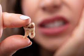 <p>tooth decay</p>