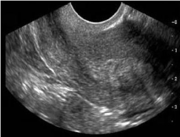 <p>where is the fibroid in the sag uterus</p><p>a) posterior fundal</p><p>b) posterior body</p><p>c) anterior fundal </p><p>d) anterior cervix</p>