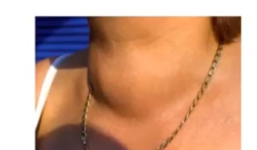 <p>hyperthyroidism </p>