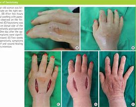 <p><span style="color: #665aea"><strong>Compartment Syndrome!!</strong></span></p>