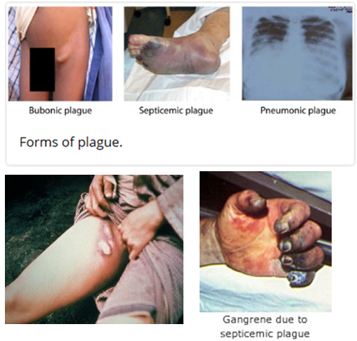 <ul><li><p><strong>Bubonic plague</strong> – Most common form; spreads via <strong>flea bites</strong> or <strong>cutaneous exposure</strong>. Causes <strong>fever, chills, headache, weakness</strong>, and <strong>painful swollen lymph nodes (buboes)</strong>.</p></li><li><p><strong>Pneumonic plague</strong> – <strong>Most severe form</strong>, the only type that spreads <strong>person-to-person</strong> via <strong>inhaled droplets</strong>. Leads to <strong>rapidly progressing pneumonia, fever, and weakness</strong>.</p></li><li><p><strong>Septicemic plague</strong> – Can result from <strong>flea bites</strong> or <strong>infected tissue handling</strong>. Symptoms include <strong>fever, shock, abdominal pain, and tissue necrosis</strong> (blackened fingers, toes, nose).</p><p></p></li></ul><p></p>