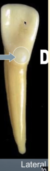 <p><mark data-color="purple" style="background-color: purple; color: inherit">mandibular lateral incisors #23 and #26; cingulum</mark></p>