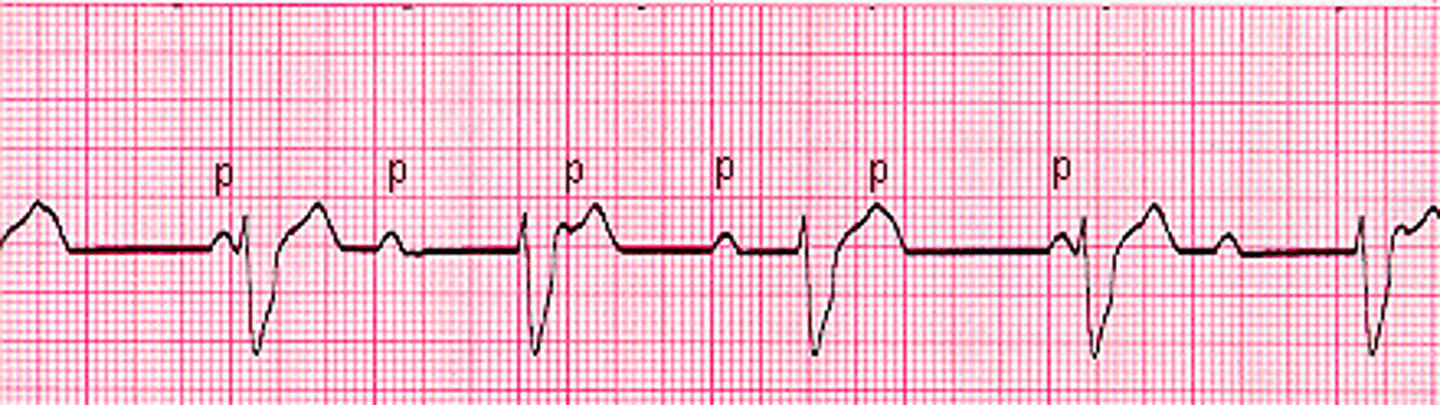 <p>Atrials and ventricles don't communicate</p><p>Rate: regular atrial</p><p>P wave: Present, upright</p><p>No relationship between P waves and QRS</p><p>PR Interval: VARIABLE</p><p>QRS: variable</p><p>P-P ad R-R consistent but NO correlation</p><p>Husband and wife live separate lives and don't communicate</p>