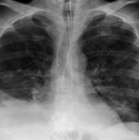 <p>describe the incorrect NG tube placement</p>