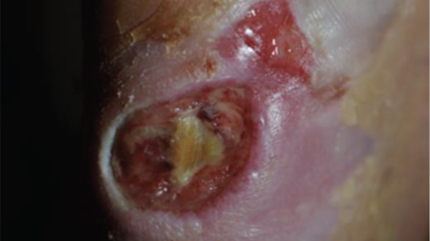 <p>B. Diabetic foot ulcer</p>