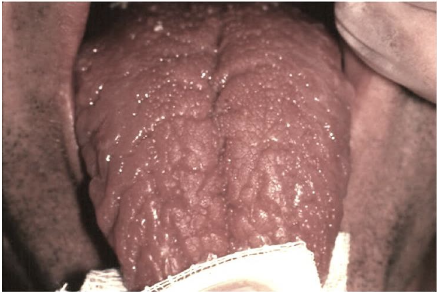 <p><strong><em>___________</em></strong>, a condition seen frequently in the general <span>population, is characterized </span>by grooves that vary in depth and are noted along the <span>dorsal and lateral aspects of </span>the tongue.</p>