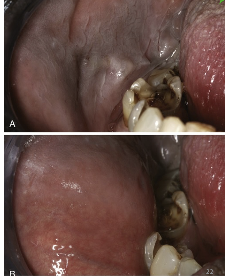 <p class="p1">White appearance <strong>diminishes or disappears</strong> with <strong>eversion of the cheek</strong></p>