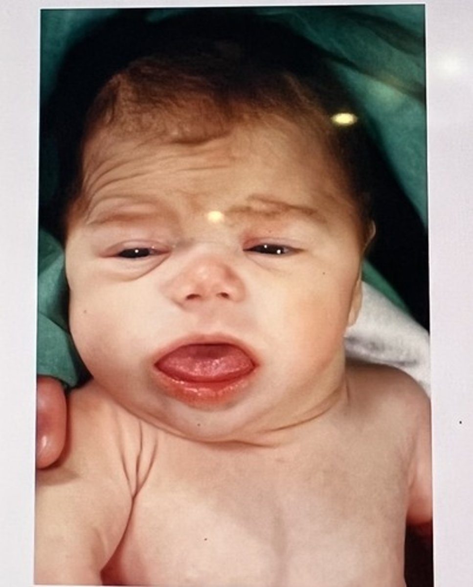 <p>Course facial features</p><p>Macroglossia</p><p>Goiter</p><p>Large fontanelles</p>