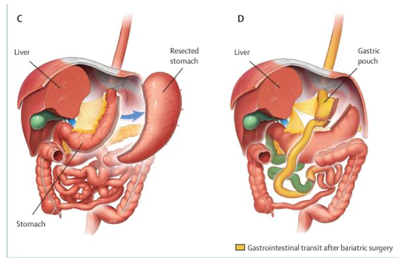 <p>reduces calorie and nutrient absorption by altering digestive tract by laparoscopic sleeve gastrectomy (restrictive) or roux-en Y gastric bypass (restrictive and malabsorptive) </p>