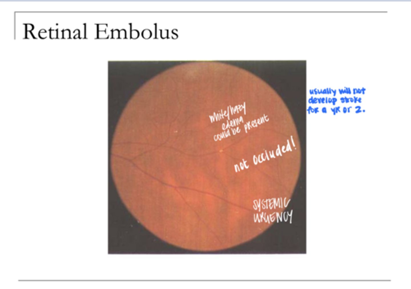 <p>Retinal Embolus (Pic)</p>