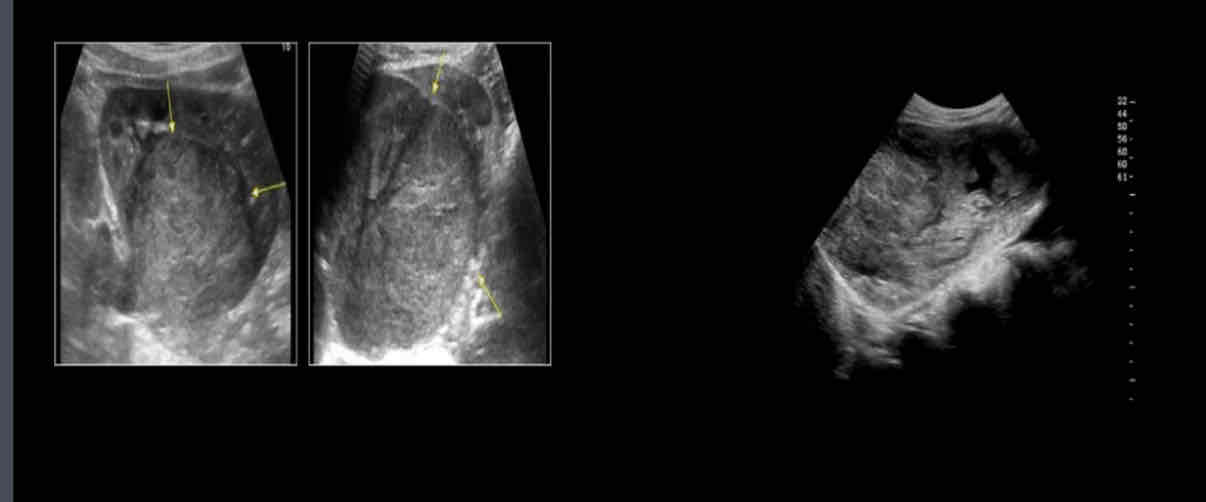 <p>What does the following sonographic appearance describe?</p><p><span>• Solid mass</span><br><span>• Varying echogenicity</span><br><span>• Areas of necrosis or hemorrhage</span><br><span>• <strong>Distorts renal parenchyma and disrupts contour but neuroblastoma(Adrenal tumor) does NOT distort/disrupt renal contour</strong></span><br><span>• Can invade IVC and renal vein</span></p>