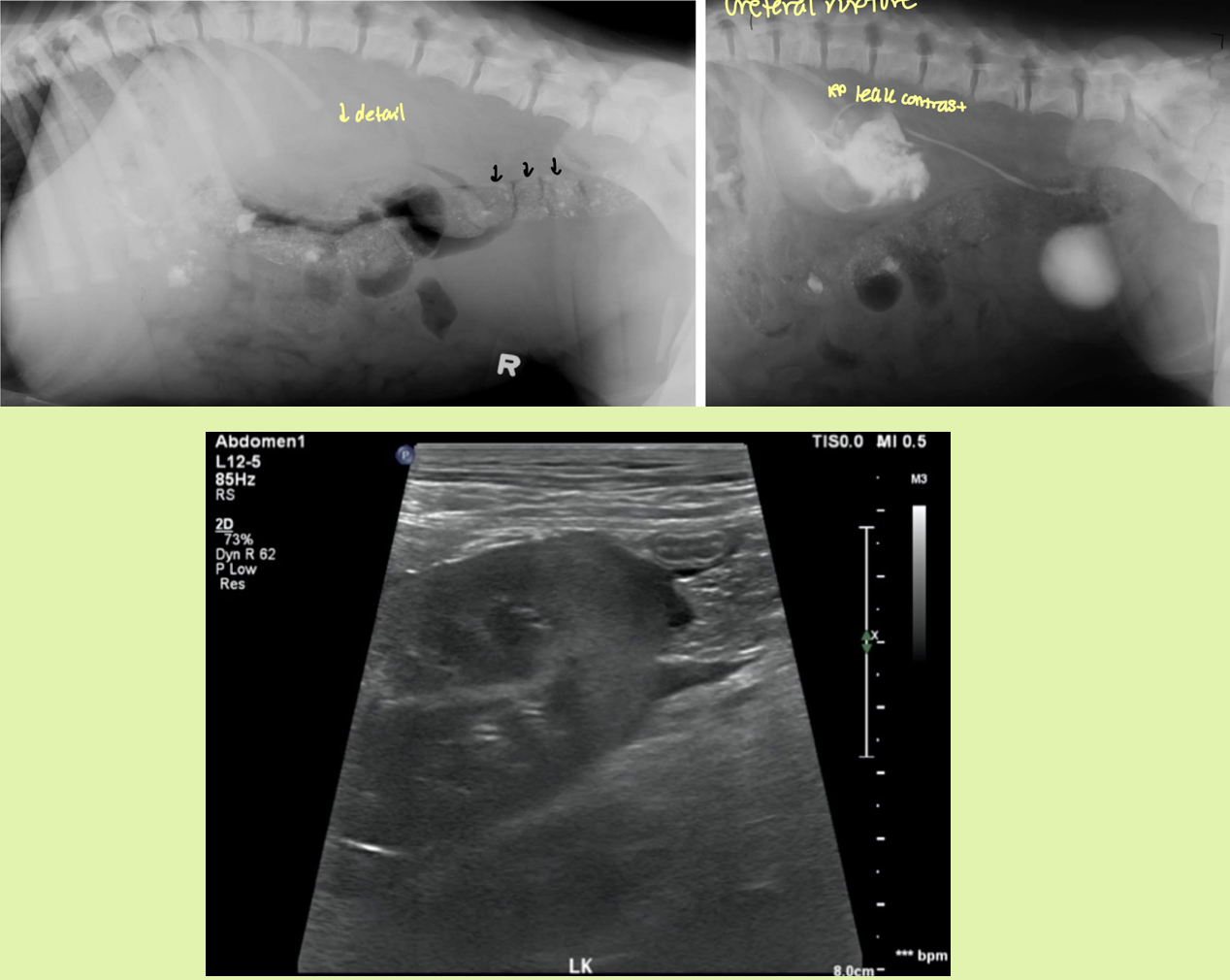 <p>ruptured ureter</p><ul><li><p>avulsion — peritoneal space</p></li><li><p>rupture — RP space</p></li></ul><p></p>