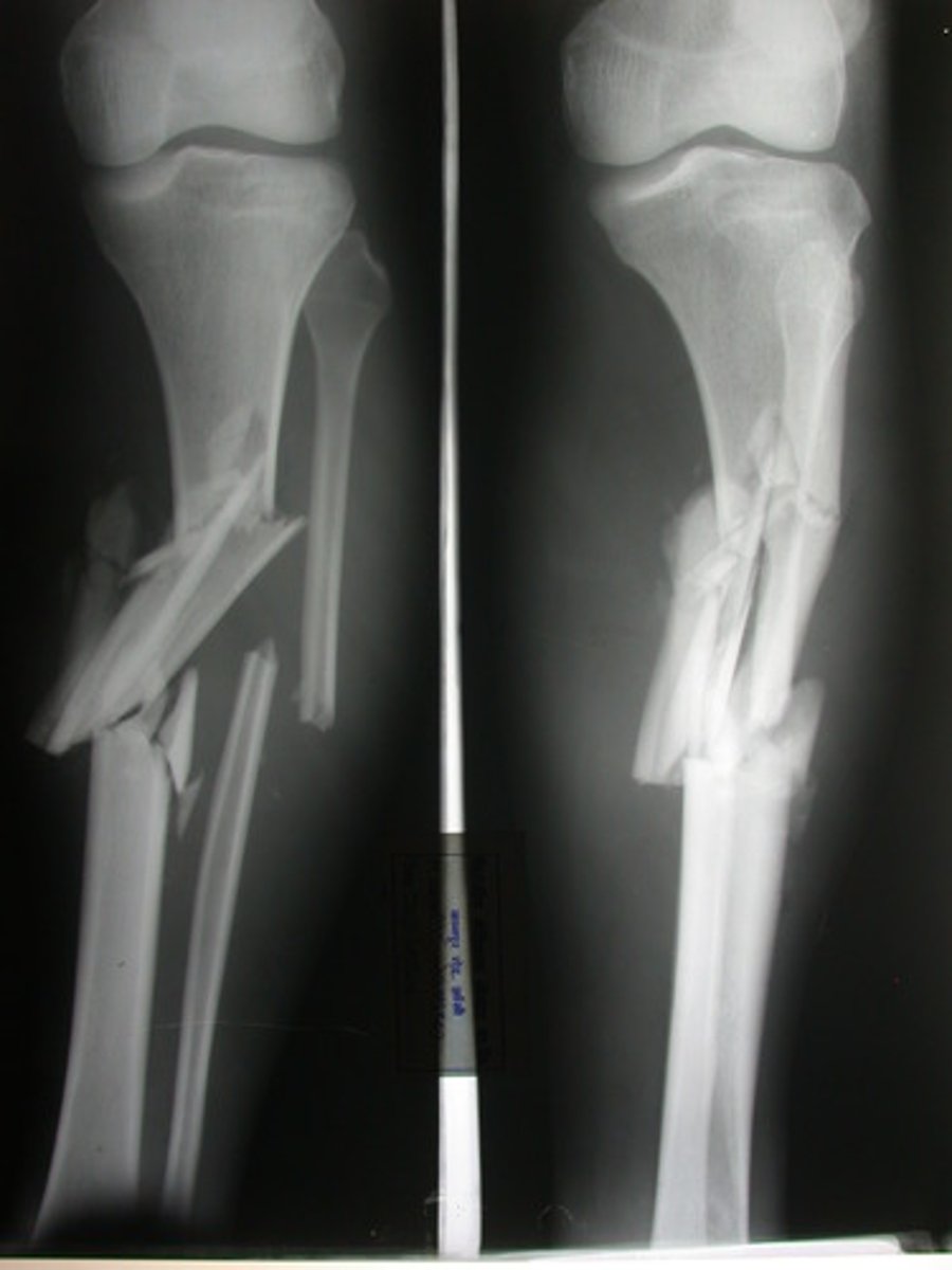 <p>fracture in which the bone is splintered or crushed</p>