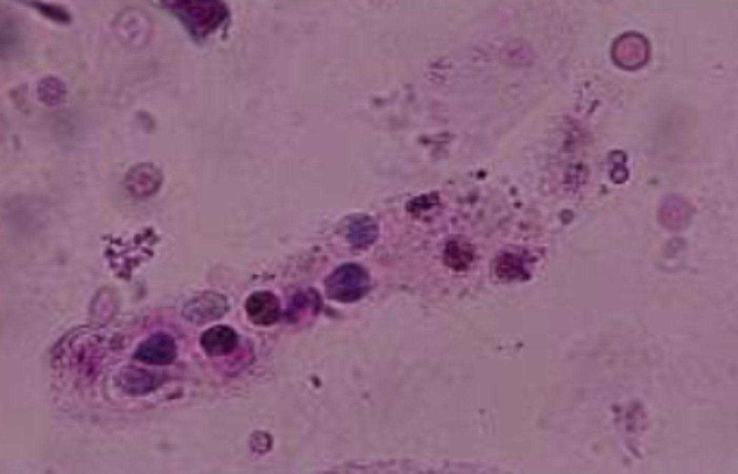 <p>- Slightly larger than RBCs</p><p>- Granular appearance</p><p>- Indicates inflammation of kidneys</p>