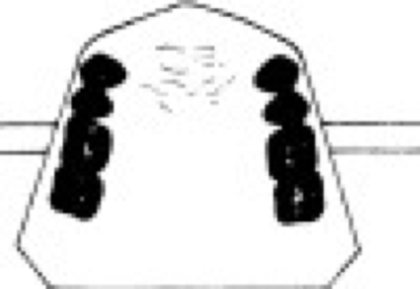 <p>Replacing 3rd molars</p>