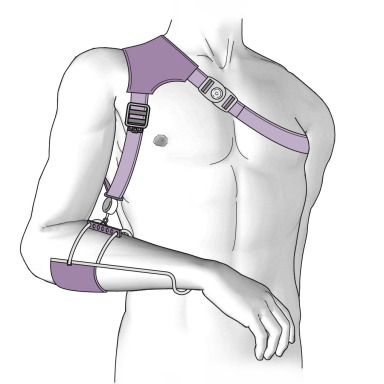<p>-Typically for brachial plexus injuries with total arm involvement, keeps the arm from flailing around</p>