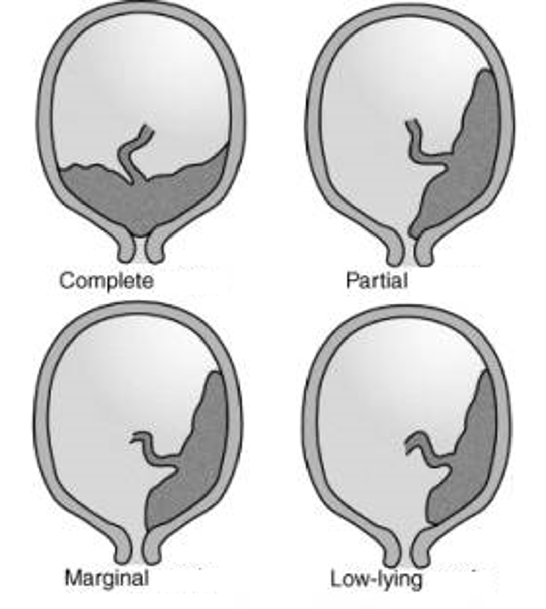 <p>-marginal- 2-3 cm of cervical os</p><p>-partial: covering cervix partially ahead of fetal presenting part</p><p>-complete: total coverage of cervical os</p><p>*can deliver vaginally w/ marginal or partial if fetus is matured but c/s indicated for complete placenta previa</p>