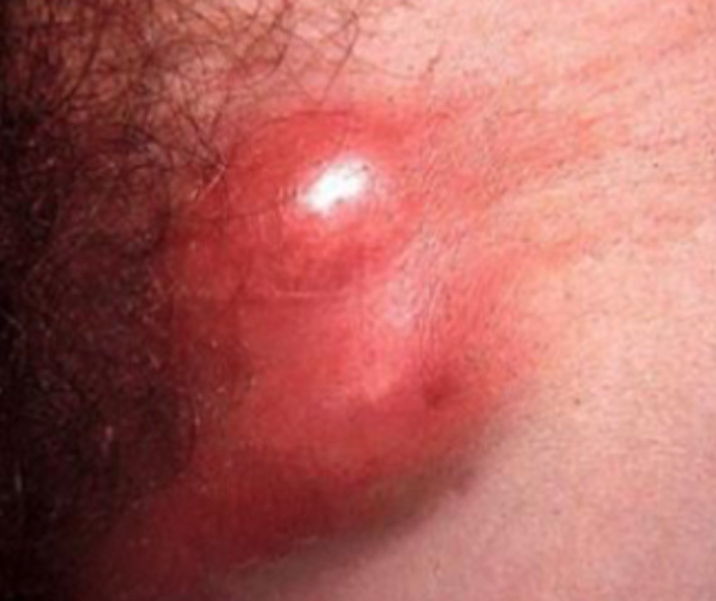 <p>Pathogen: Chlamydia trachomatis</p><p>S+S: Small, painless, ulcer on the genitals --&gt; chronic inflammation of the lymphatic vessels and lymph nodes --&gt; buboes</p><p>Transmission: Person-to-person by sexual contact</p>