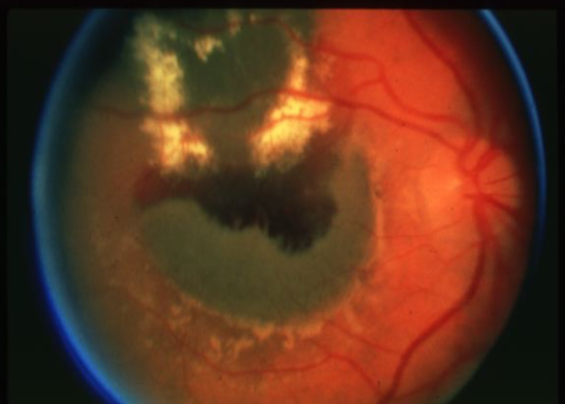 <p>what is the concern for this being melanoma? </p>