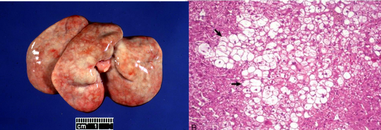 <p>what is being shown in this liver **</p>