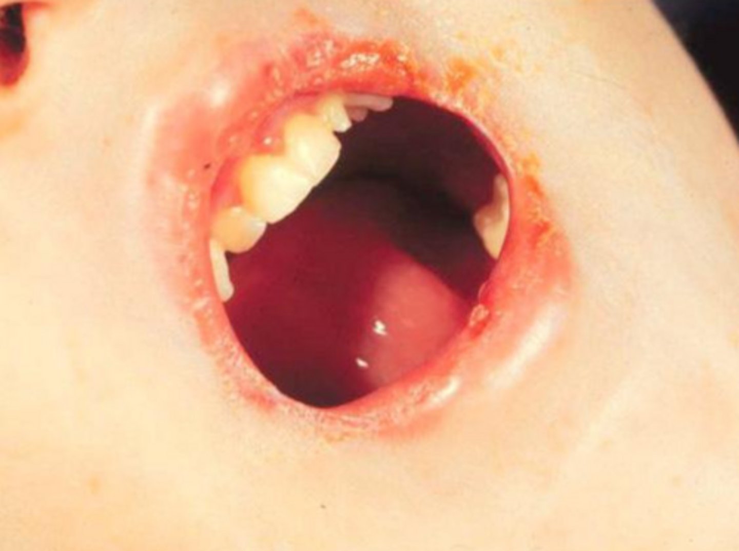 <p>false; vesicles and bullae associated with epidermolysis bullosa are caused by major traumas. oral lesions will heal with scarring, and restrict opening.</p>