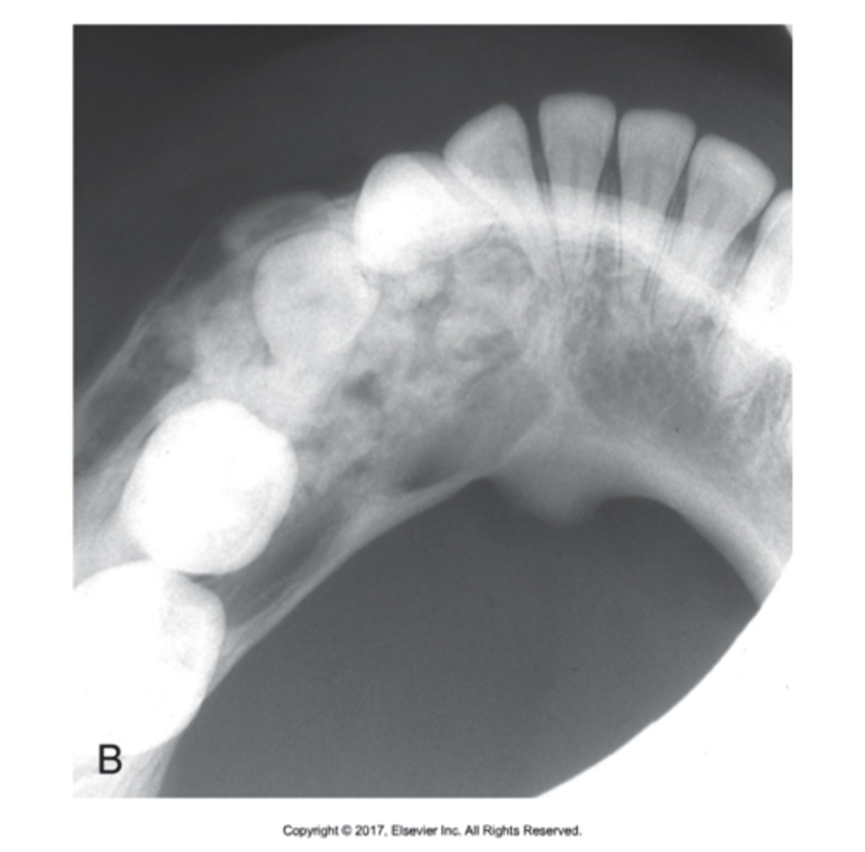 <p>Exhibits both a radiopaque and a radiolucent component</p>