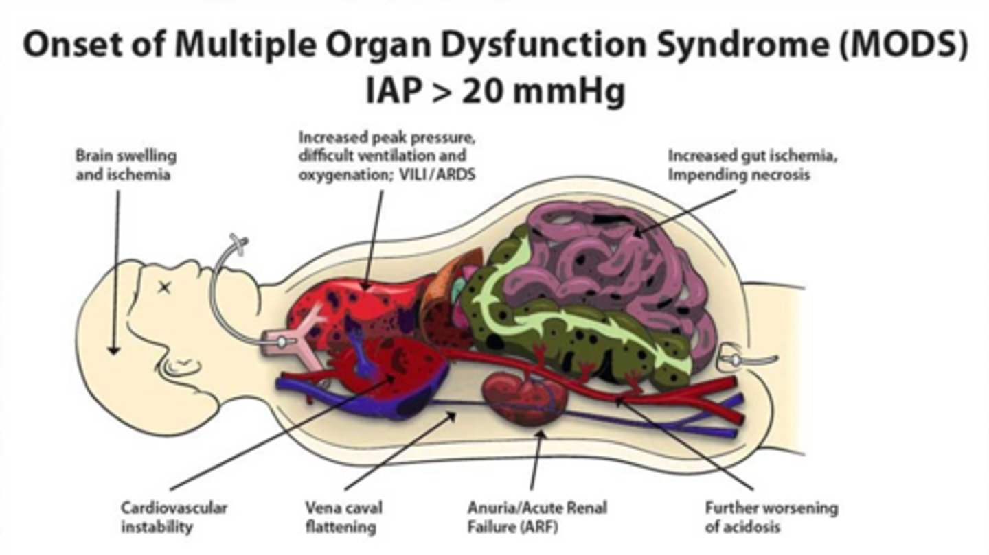 <p>- intrabdomnial hypertension (results in MODS)</p><p>- abnormally increased pressure within the abdomen that is assoc. w/ organ dysfunction</p><p>- risk factors: trauma, surgery, infection</p><p>- causes: brain swelling/ischemia, decreased cardiac output, IVC blood flow obstruction (diminished BF to LE), arterial hypoxemia/hypercarbia, impaired venous damage (major cause of renal impairment), hypoperfusion/ischemia of bowel d/t decreased mesenteric blood flow</p><p>- clinical manifestations: abdominal distention/tense, rigid abdomen; disproportionate abdominal pain; tachypnea and/or dyspnea</p><p>- treatment: Emergency!! Immediately to OR for exploratory laparotomy, NEED TO RELIEVE THIS PRESSURE</p>