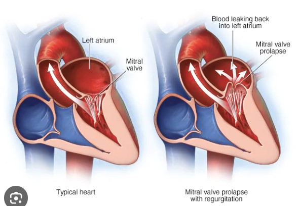 <ul><li><p><span style="font-family: Calibri, sans-serif">Heart murmurs</span></p><ul><li><p><span style="font-family: Calibri, sans-serif">Valve irregularity, septal defect, persistent fetal opening (foramen ovale) between the right and left atria after birth</span></p></li></ul></li><li><p><span style="font-family: Calibri, sans-serif">Mitral valve prolapse</span></p><ul><li><p><span style="font-family: Calibri, sans-serif">Most common cause of chronic mitral regurgitation, where blood flows backward into left atrium</span></p></li><li><p><span style="font-family: Calibri, sans-serif">Can be congenital or acquired, people may live without symptoms, and others may need mitral valve to be repaired or replaced</span></p></li></ul></li></ul>
