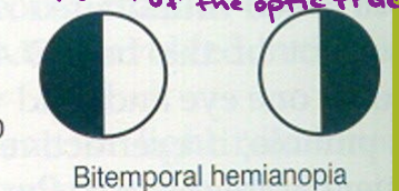 <p>If the patient had this visual defect, where would you expect a lesion to be?</p>