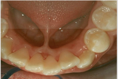 <p><span style="color: #000000">Abnormally short, thick lingual frenum resulting in limitation of tongue movement. May cause problems with speech and breastfeeding. You’d need a frenectomy</span></p>