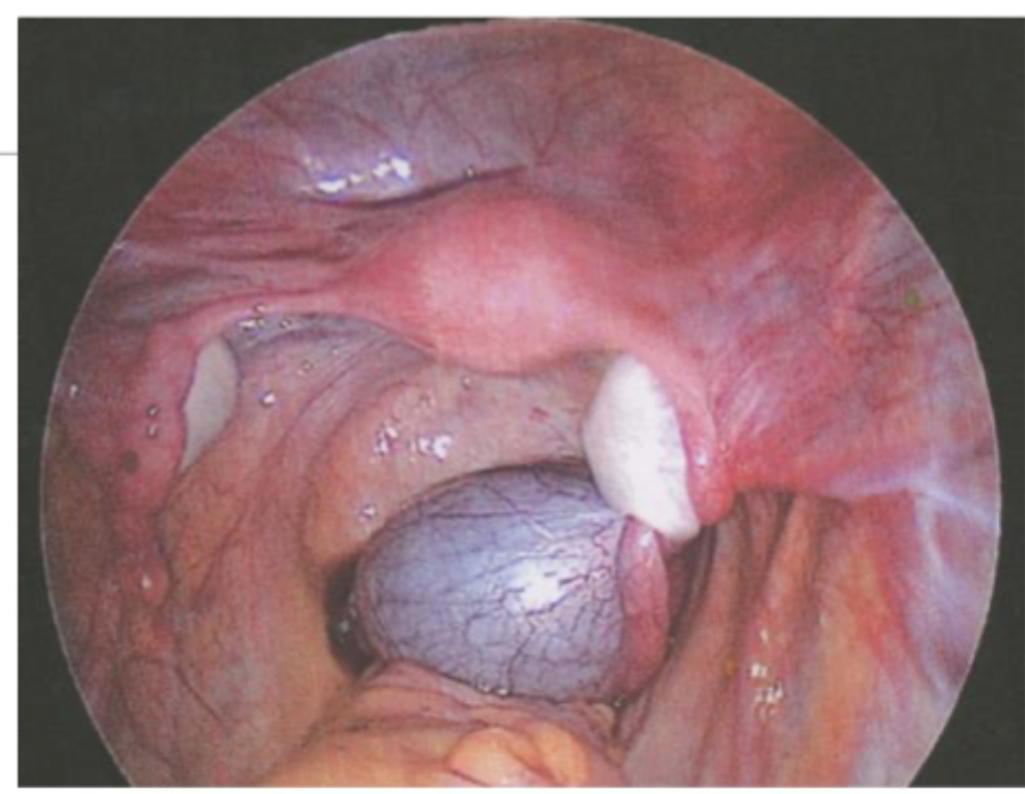<p>Management of Adnexal Torsion</p>
