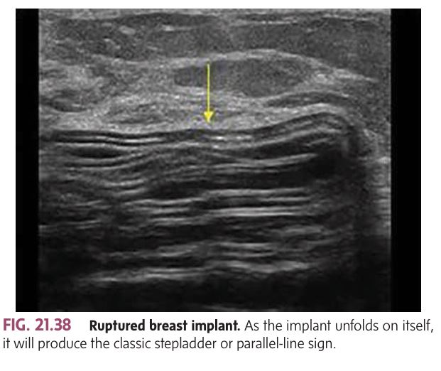 <p>Intracapsular Rupture : As the implant folds on itself, it will produce the </p>