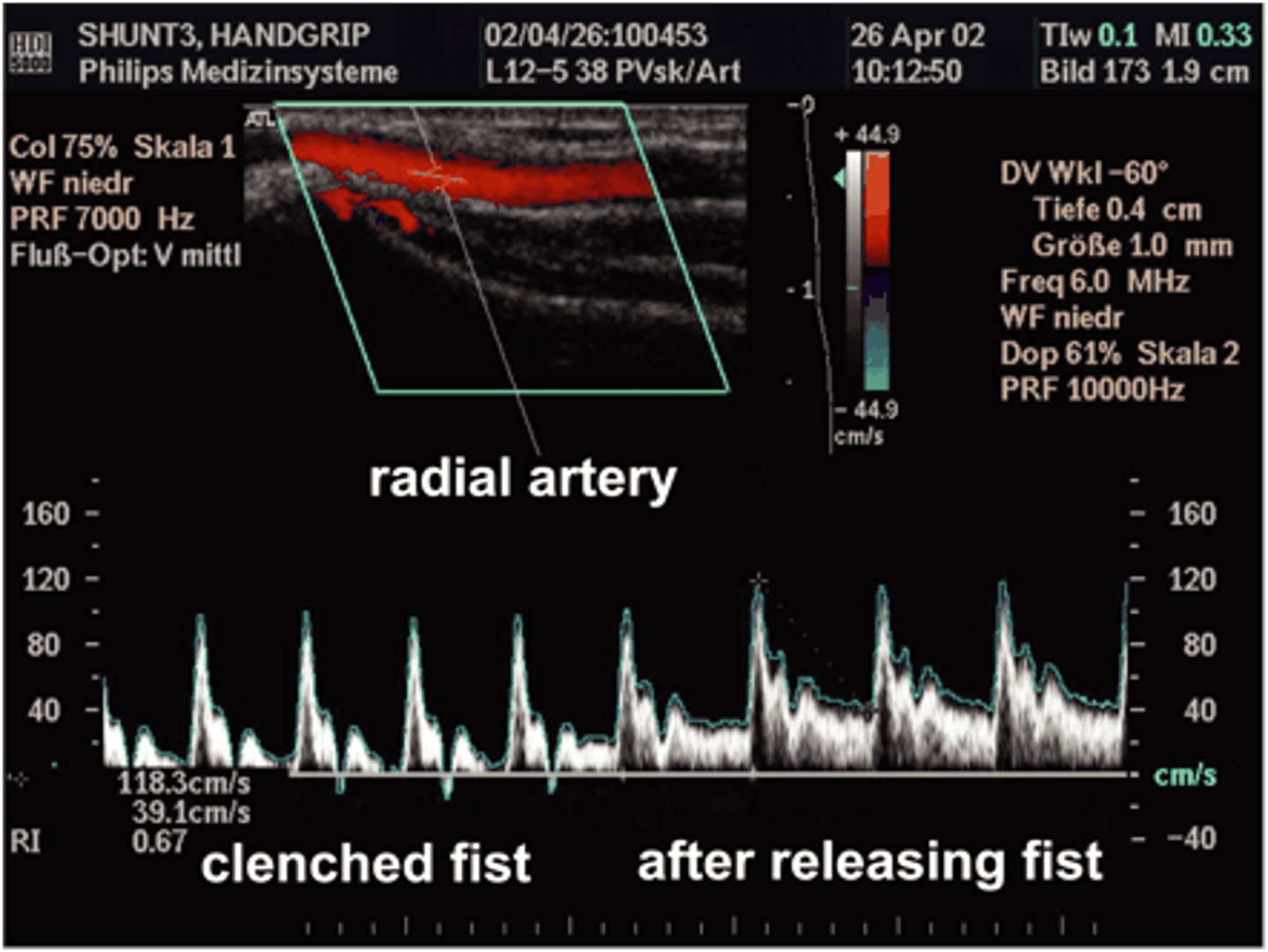 <p>the fist clenching increases peripheral resistance so the waveform becomes triphasic but when the fist is released blood flow freely and continuously so it becomes a low resistance pattern</p>