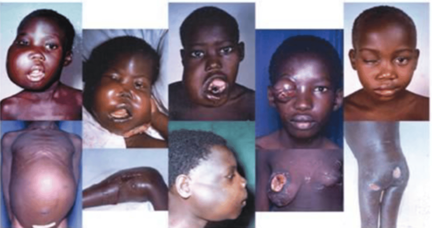 <p>endemiczna choroba</p><p>wirus EBV</p>