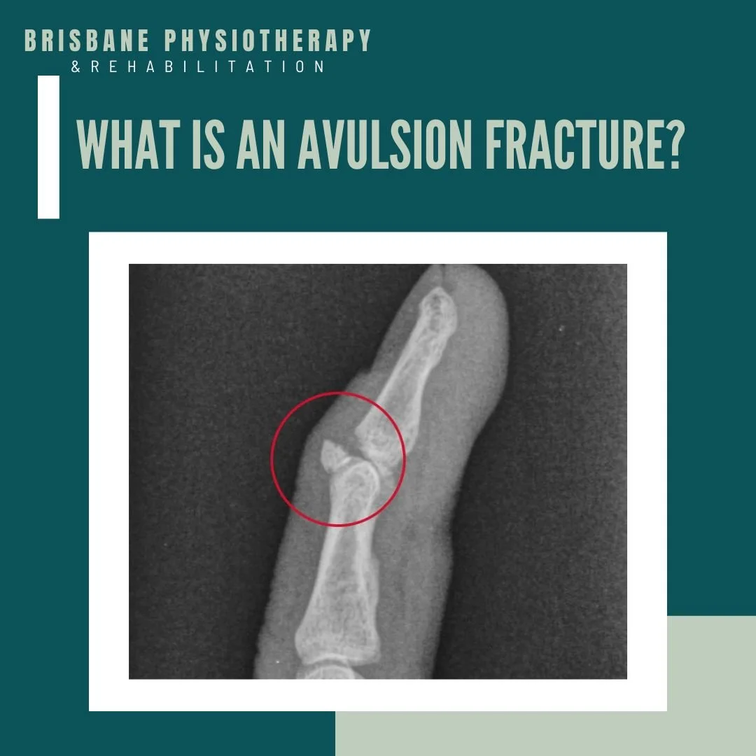 <p>An avulsion fracture occurs when a small piece of bone is pulled off by a tendon or ligament, usually at the site of attachment.</p>