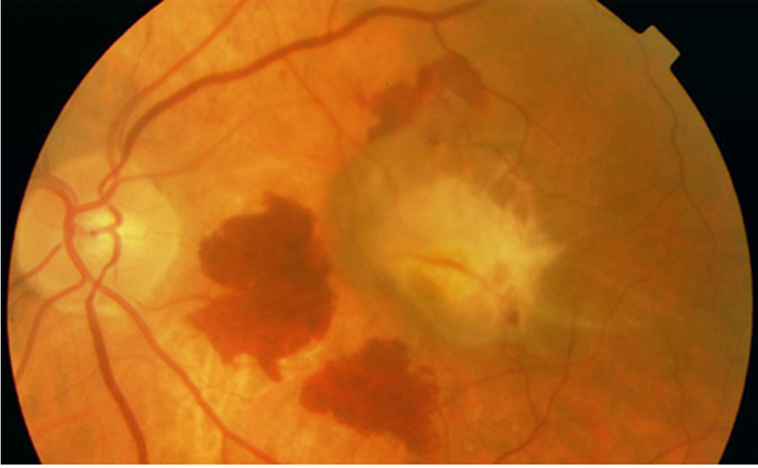 <p>macular sub retinal fibrosis and hemorrhages; sudden vision loss</p>