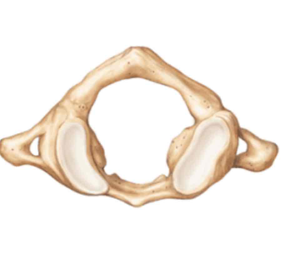 <p>Name this special cervical vertebrae and its defining factor</p>