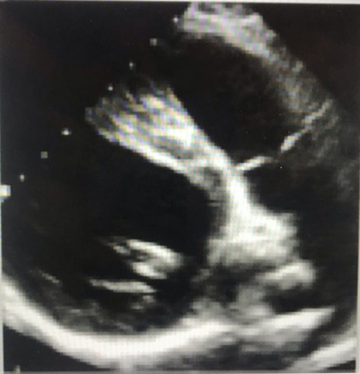 <p>left posterior pulmonic cusp</p>
