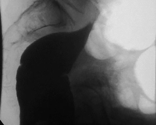 <p>How is volvulus classified?</p>