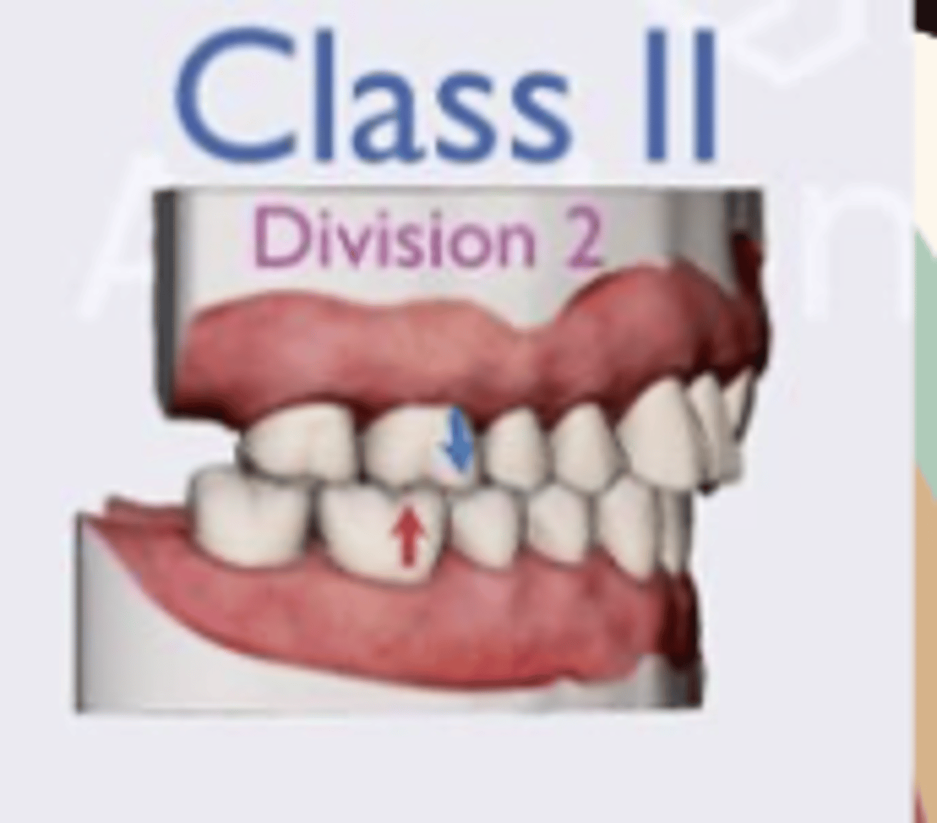 <p>The mandible is retruded and maxillary incisors are upright or retruded and maxillary lateral incisors are inclined labially or overlapping central incisors. </p>