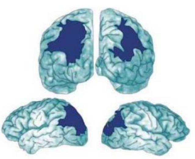 ➔ La voie du « WHERE » touchée.
La triade : ataxie optique + apraxie du regard (apraxie oculomotrice) + simultagnosie. Il s’agit d’un trouble neuro-visuel rare. Les trois symptômes peuvent apparaitre séparément.
Il s’agit de lésions bilatérales des parties postérieures des lobes pariétaux et de la jonction pariéto-occipitale. Les lésions unilatérales sont des formes mineures. Les patients ont un comportement donnant l’impression qu’ils sont aveugles, alors même qu’ils peuvent reconnaitre certains objets dans leur environnement (voie du « what » préservée). Leurs voies visuelles depuis la rétine jusqu’au cortex visuel primaires sont intactes.
Ce syndrome peut passer inaperçu en phase aigüe ; il est masqué par des troubles de la vigilance, une hémiplégie ou une cécité corticale (comme dans l’hémianopsie).
➢ Le patient peut ne pas s’en plaindre spontanément.