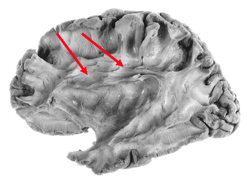 <p>which cerebral fiber pathway </p>